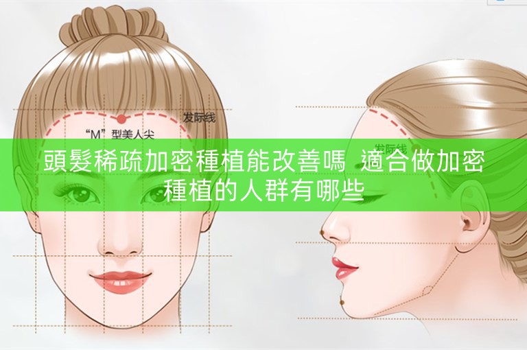 頭髮稀疏加密種植能改善嗎 適合做加密種植的人群有哪些 頭髮稀疏加密種植能改善嗎 適合做加密種植的人群有哪些