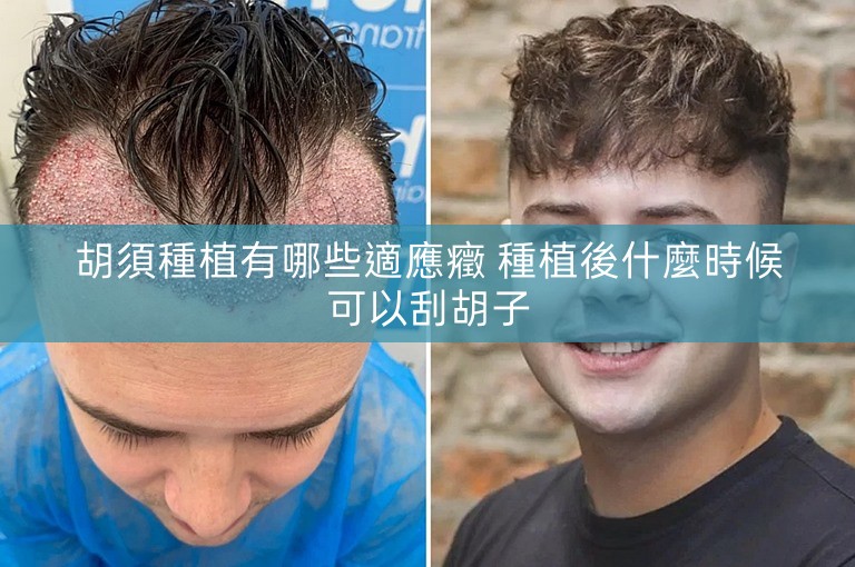 胡須種植有哪些適應癥 種植後什麼時候可以刮胡子 胡須種植有哪些適應癥 種植後什麼時候可以刮胡子