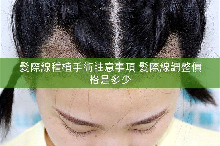 髮際線種植手術註意事項 髮際線調整價格是多少