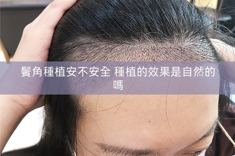 鬢角種植安不安全 種植的效果是自然的嗎