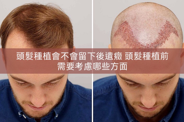 頭髮種植會不會留下後遺癥 頭髮種植前需要考慮哪些方面