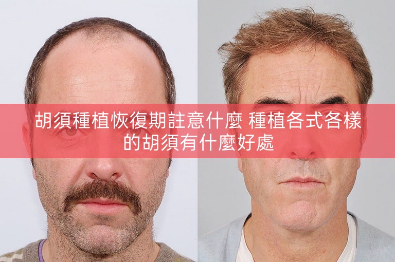 胡須種植恢復期註意什麼 種植各式各樣的胡須有什麼好處
