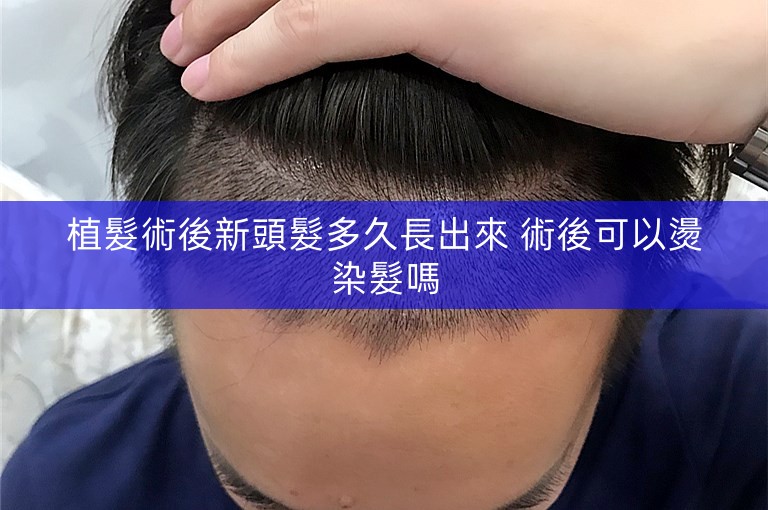 植髮術後新頭髮多久長出來 術後可以燙染髮嗎