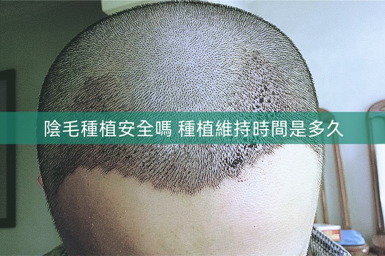 陰毛種植安全嗎 種植維持時間是多久