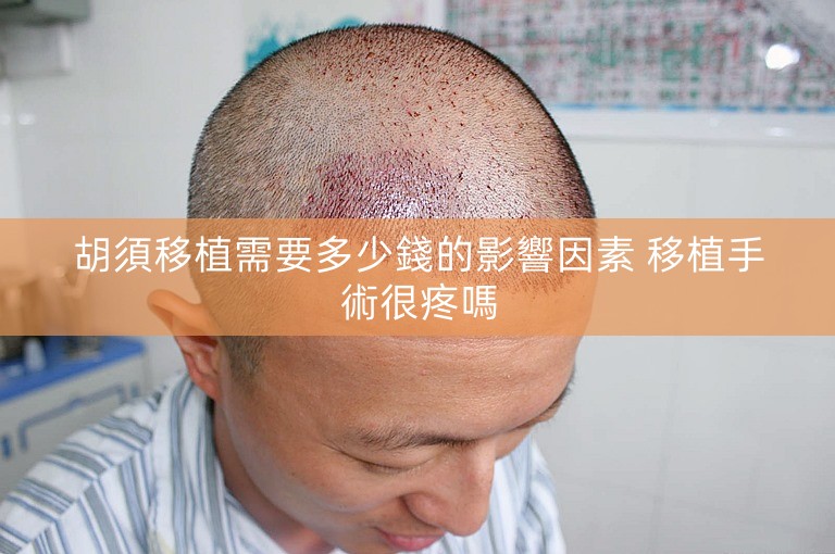 胡須移植需要多少錢的影響因素 移植手術很疼嗎 胡須移植需要多少錢的影響因素 移植手術很疼嗎