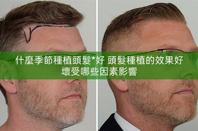 什麼季節種植頭髮*好 頭髮種植的效果好壞受哪些因素影響