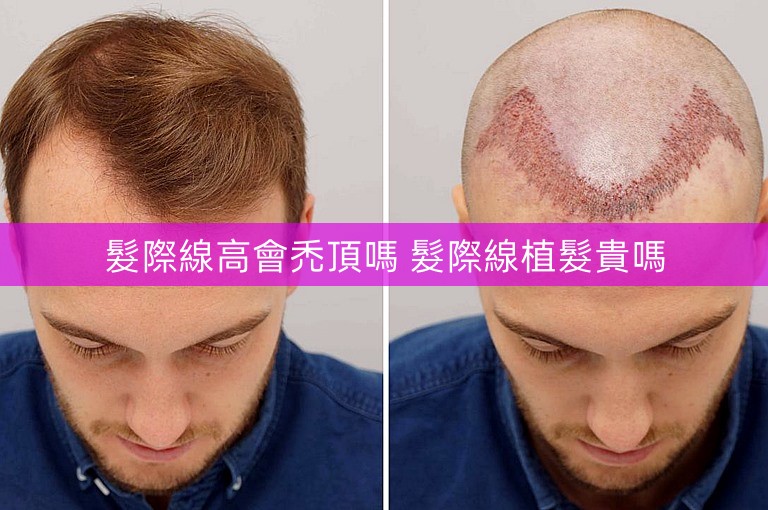 髮際線高會禿頂嗎 髮際線植髮貴嗎