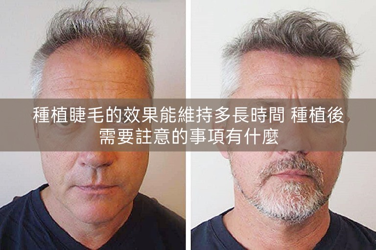 種植睫毛的效果能維持多長時間 種植後需要註意的事項有什麼