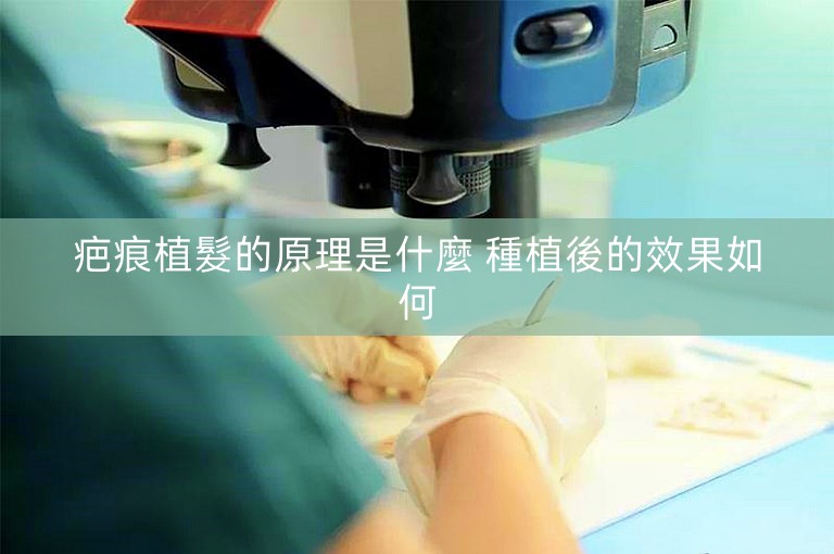 疤痕植髮的原理是什麼 種植後的效果如何