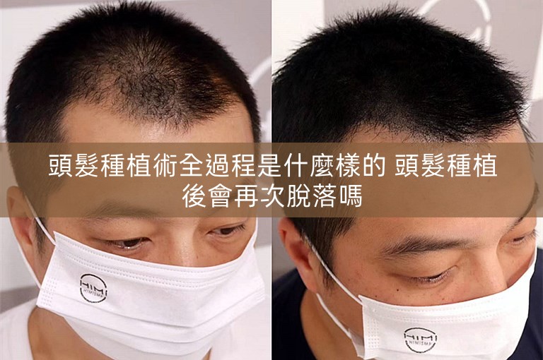 頭髮種植術全過程是什麼樣的 頭髮種植後會再次脫落嗎
