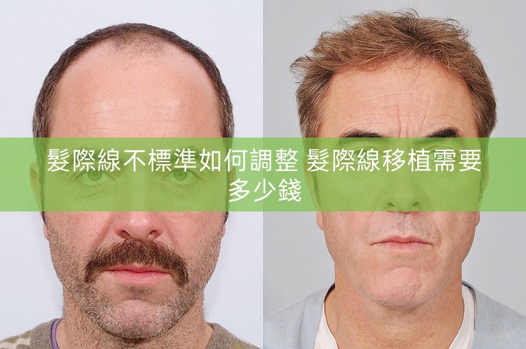 髮際線不標準如何調整 髮際線移植需要多少錢