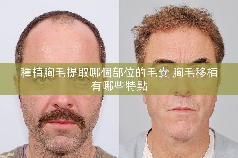 種植胸毛提取哪個部位的毛囊 胸毛移植有哪些特點