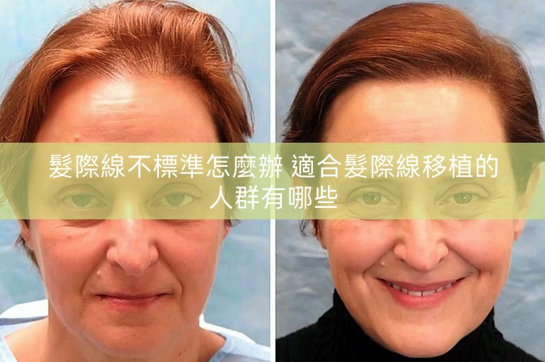 髮際線不標準怎麼辦 適合髮際線移植的人群有哪些