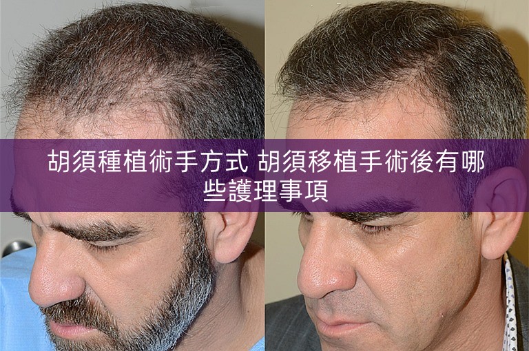 胡須種植術手方式 胡須移植手術後有哪些護理事項