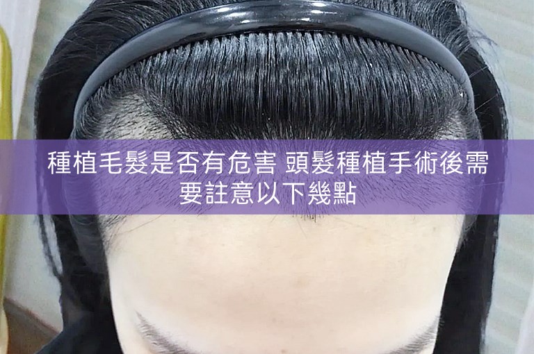 種植毛髮是否有危害 頭髮種植手術後需要註意以下幾點