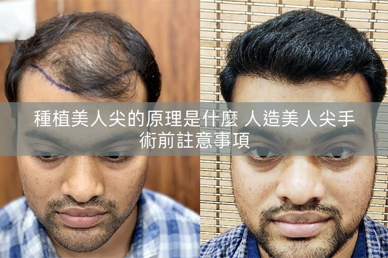 種植美人尖的原理是什麼 人造美人尖手術前註意事項