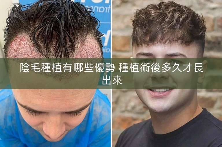 陰毛種植有哪些優勢 種植術後多久才長出來