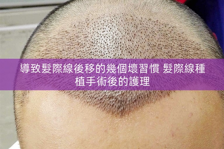 導致髮際線後移的幾個壞習慣 髮際線種植手術後的護理 導致髮際線後移的幾個壞習慣 髮際線種植手術後的護理