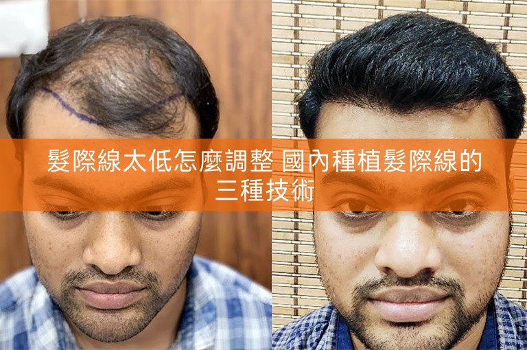 髮際線太低怎麼調整 國內種植髮際線的三種技術