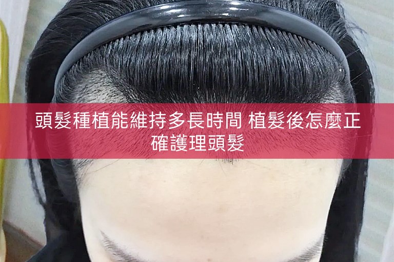 頭髮種植能維持多長時間 植髮後怎麼正確護理頭髮 頭髮種植能維持多長時間 植髮後怎麼正確護理頭髮