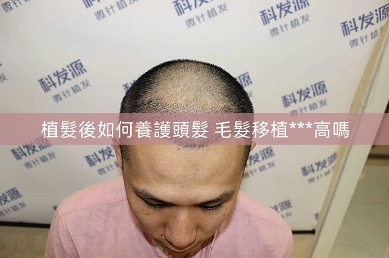 植髮後如何養護頭髮 毛髮移植***高嗎