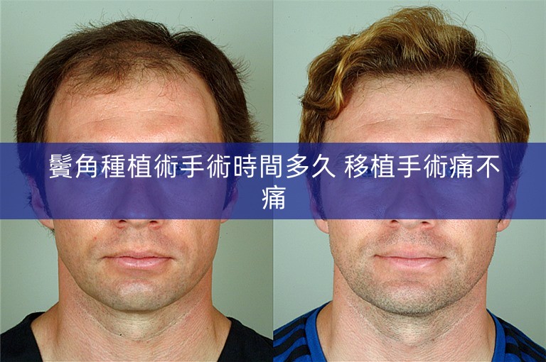 鬢角種植術手術時間多久 移植手術痛不痛