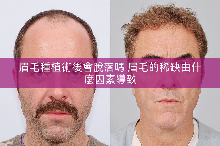 眉毛種植術後會脫落嗎 眉毛的稀缺由什麼因素導致