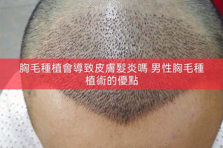 胸毛種植會導致皮膚髮炎嗎 男性胸毛種植術的優點