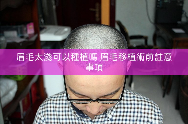 眉毛太淺可以種植嗎 眉毛移植術前註意事項