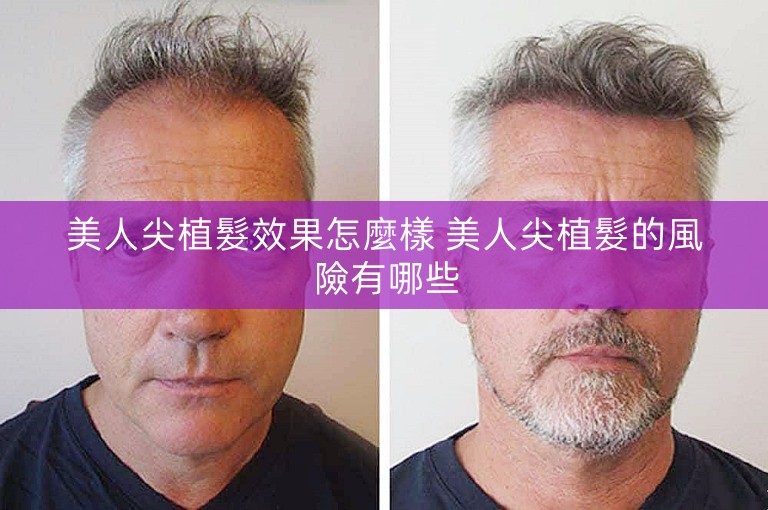 美人尖植髮效果怎麼樣 美人尖植髮的風險有哪些