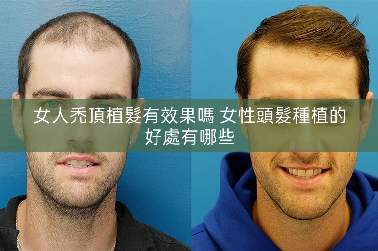 女人禿頂植髮有效果嗎 女性頭髮種植的好處有哪些