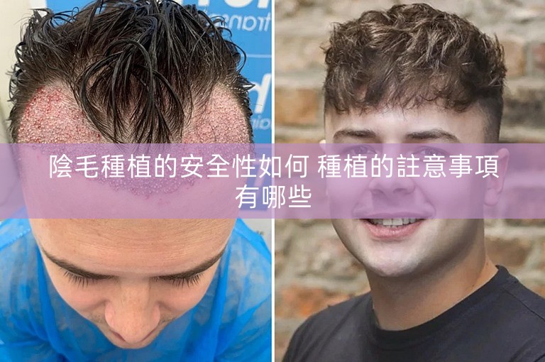 陰毛種植的安全性如何 種植的註意事項有哪些