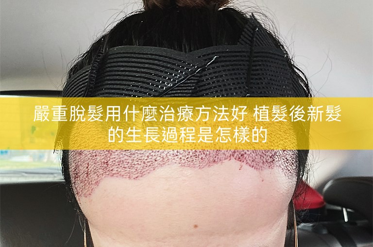 嚴重脫髮用什麼治療方法好 植髮後新髮的生長過程是怎樣的