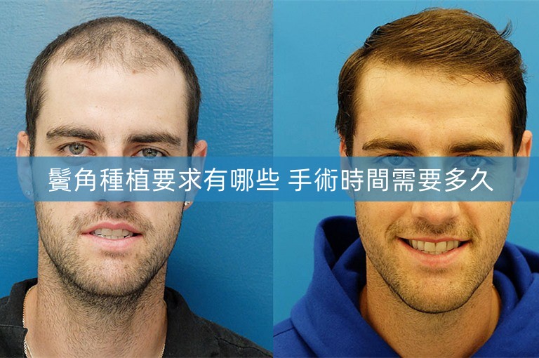 鬢角種植要求有哪些 手術時間需要多久