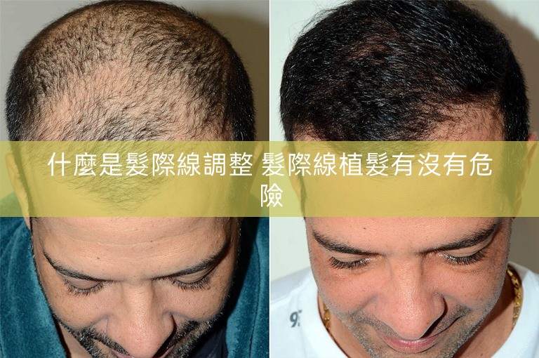 什麼是髮際線調整 髮際線植髮有沒有危險