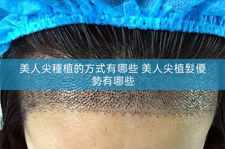 美人尖種植的方式有哪些 美人尖植髮優勢有哪些