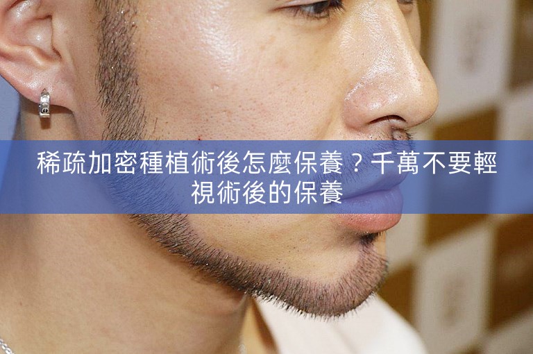 稀疏加密種植術後怎麼保養？千萬不要輕視術後的保養