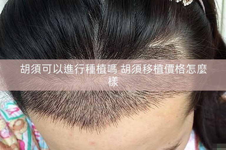 胡須可以進行種植嗎 胡須移植價格怎麼樣 胡須可以進行種植嗎 胡須移植價格怎麼樣