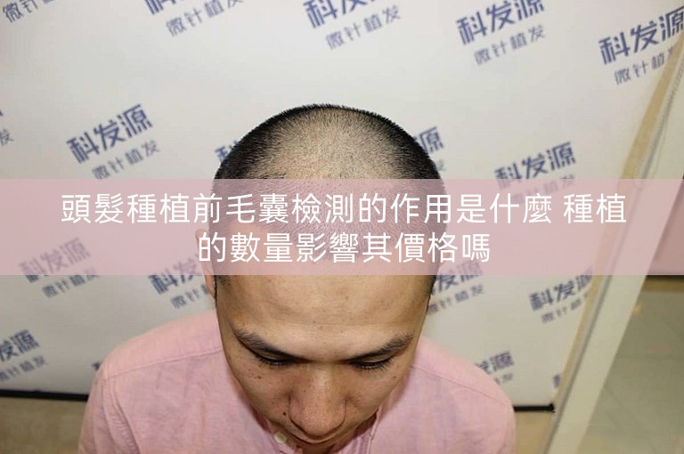 頭髮種植前毛囊檢測的作用是什麼 種植的數量影響其價格嗎