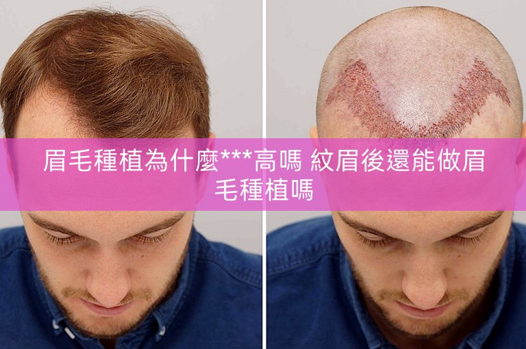 眉毛種植為什麼***高嗎 紋眉後還能做眉毛種植嗎