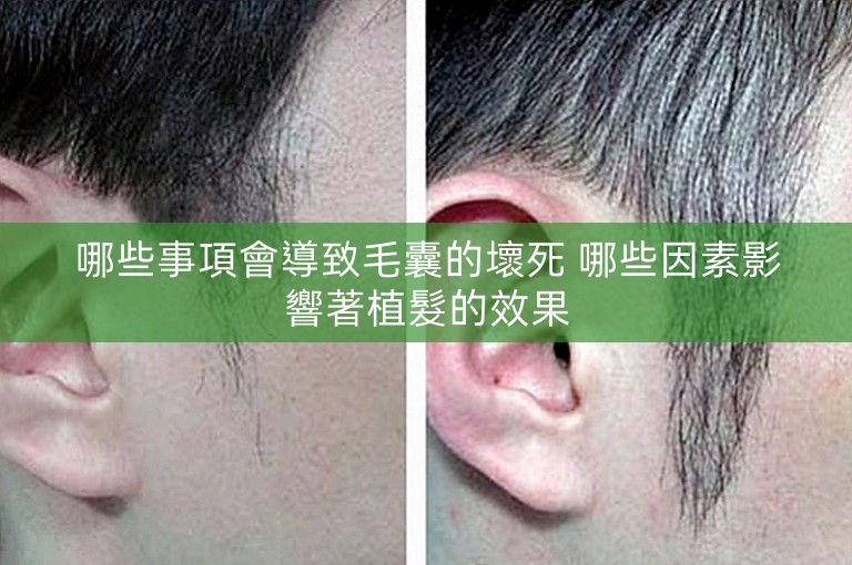 哪些事項會導致毛囊的壞死 哪些因素影響著植髮的效果