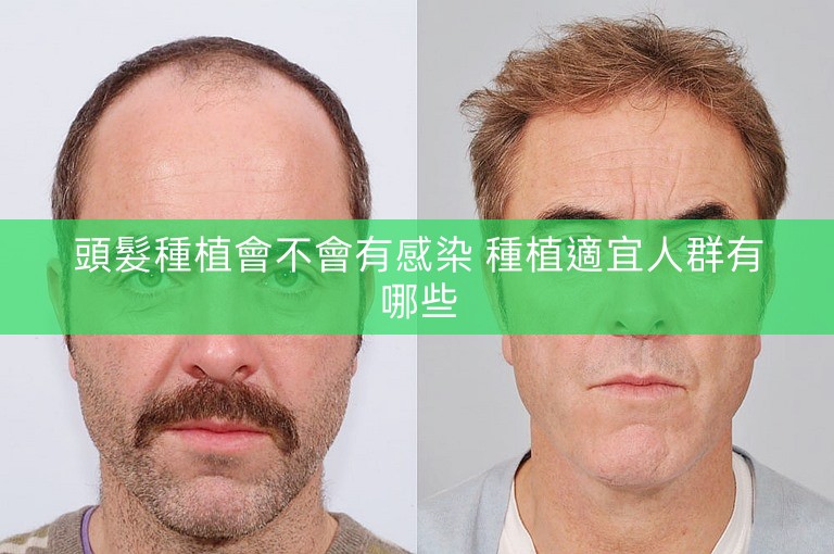 頭髮種植會不會有感染 種植適宜人群有哪些