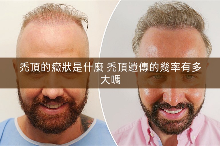 禿頂的癥狀是什麼 禿頂遺傳的幾率有多大嗎