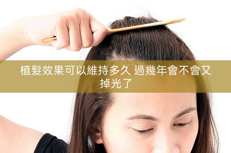 植髮效果可以維持多久 過幾年會不會又掉光了