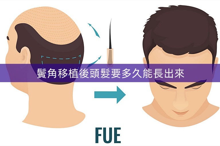 鬢角移植後頭髮要多久能長出來