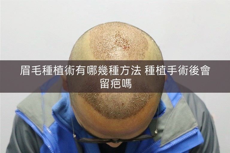 眉毛種植術有哪幾種方法 種植手術後會留疤嗎