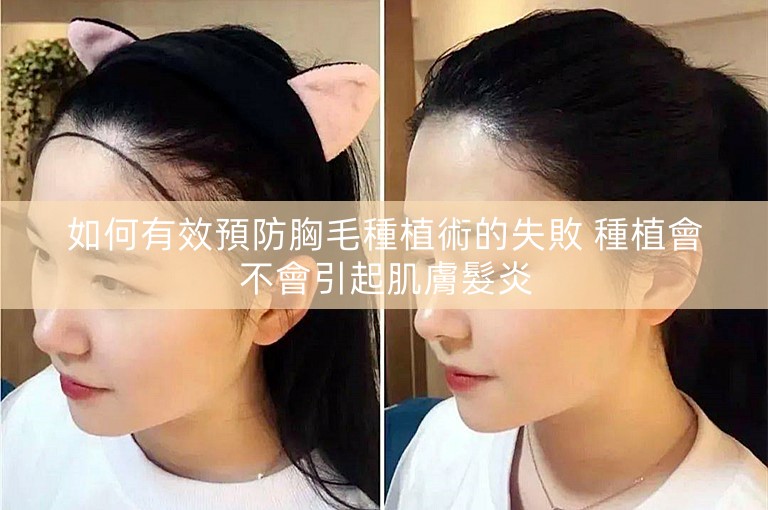 如何有效預防胸毛種植術的失敗 種植會不會引起肌膚髮炎 如何有效預防胸毛種植術的失敗 種植會不會引起肌膚髮炎