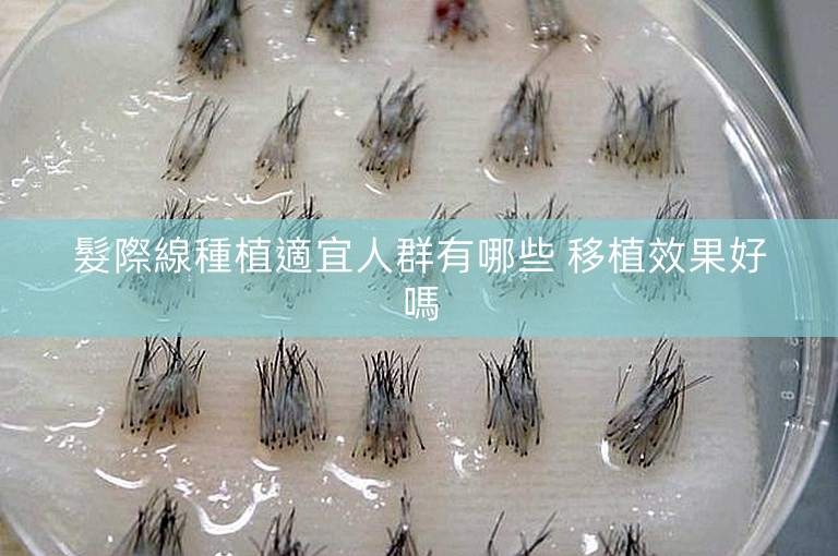 髮際線種植適宜人群有哪些 移植效果好嗎