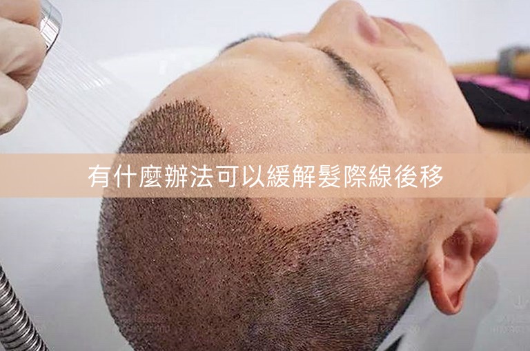 有什麼辦法可以緩解髮際線後移