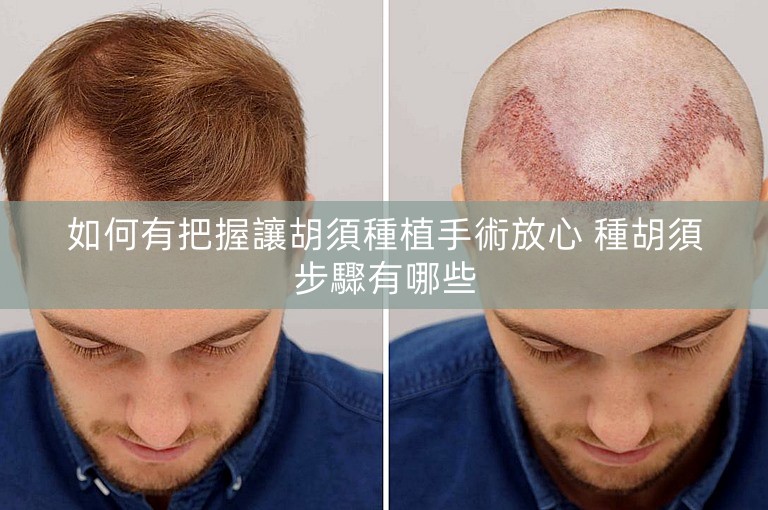 如何有把握讓胡須種植手術放心 種胡須步驟有哪些